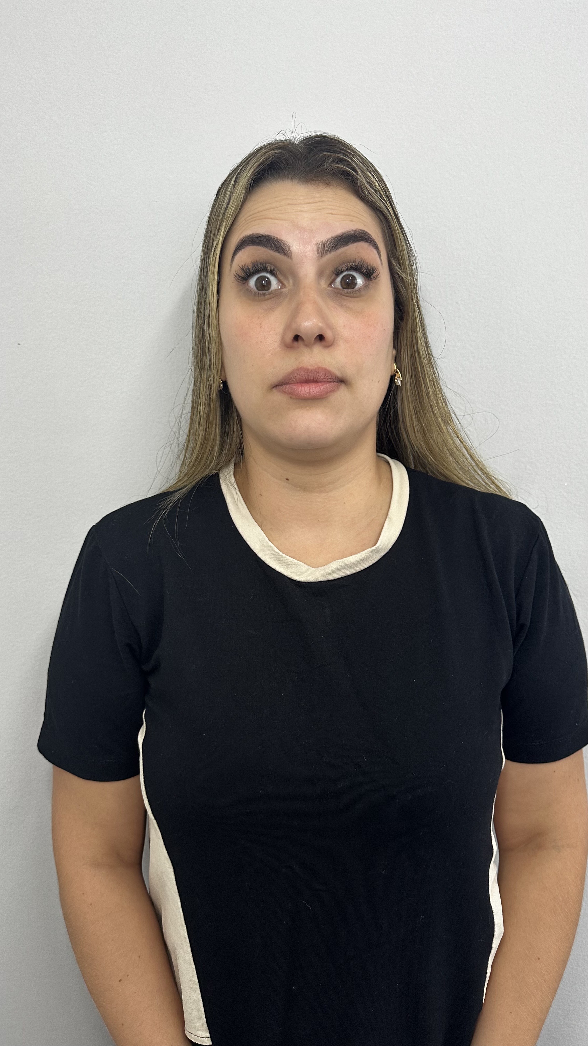 Antes - Toxina Botulínica