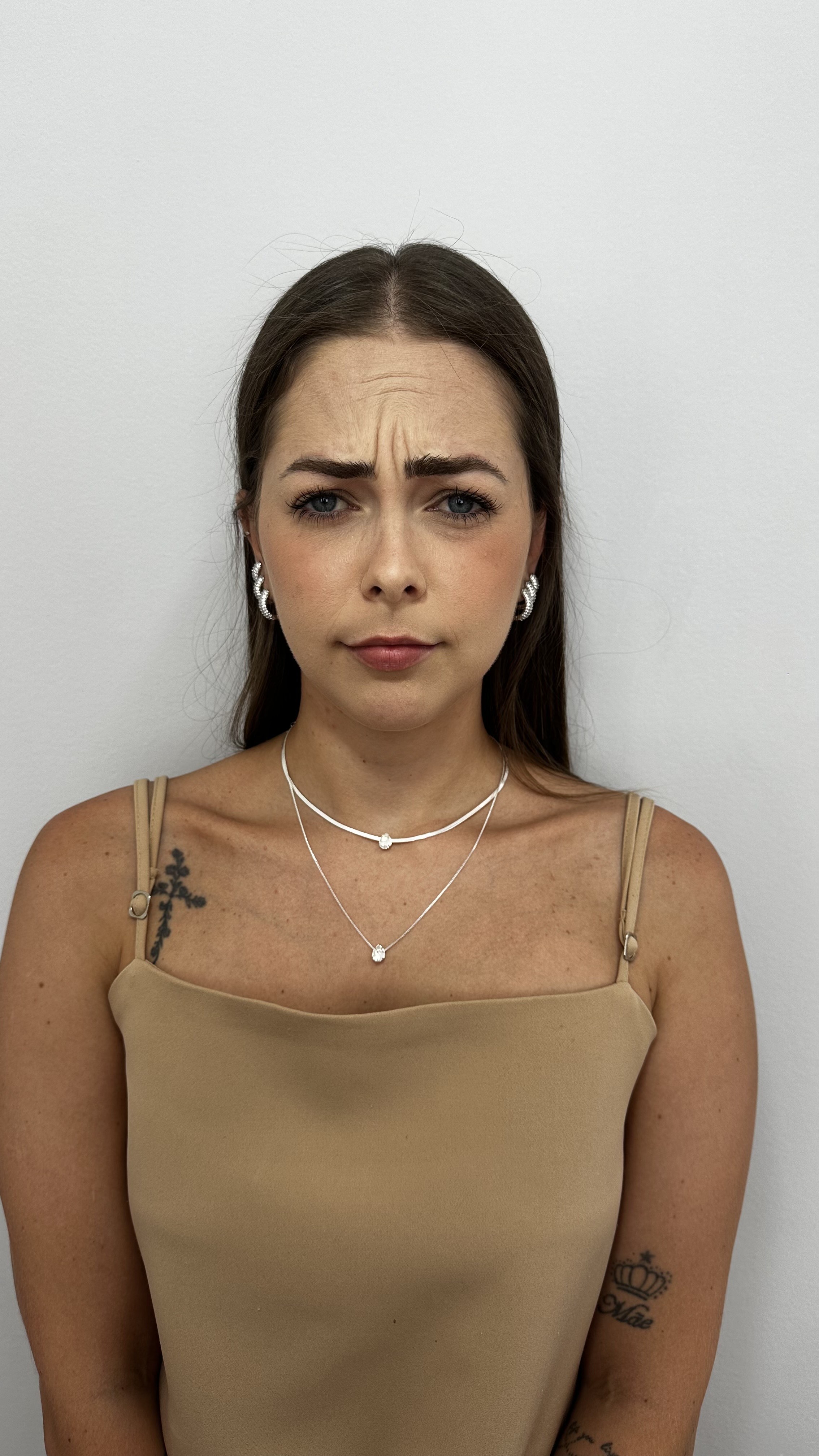 Antes - Toxina Botulínica