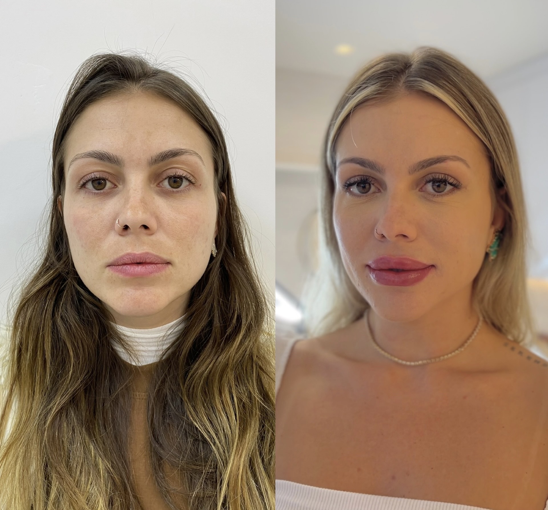 Resultado de Preenchimento FULL face