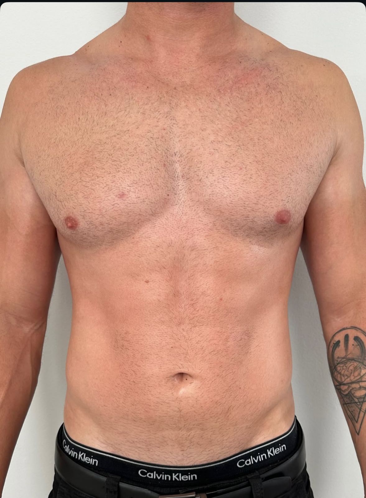 Depois - Lipo Enzimática