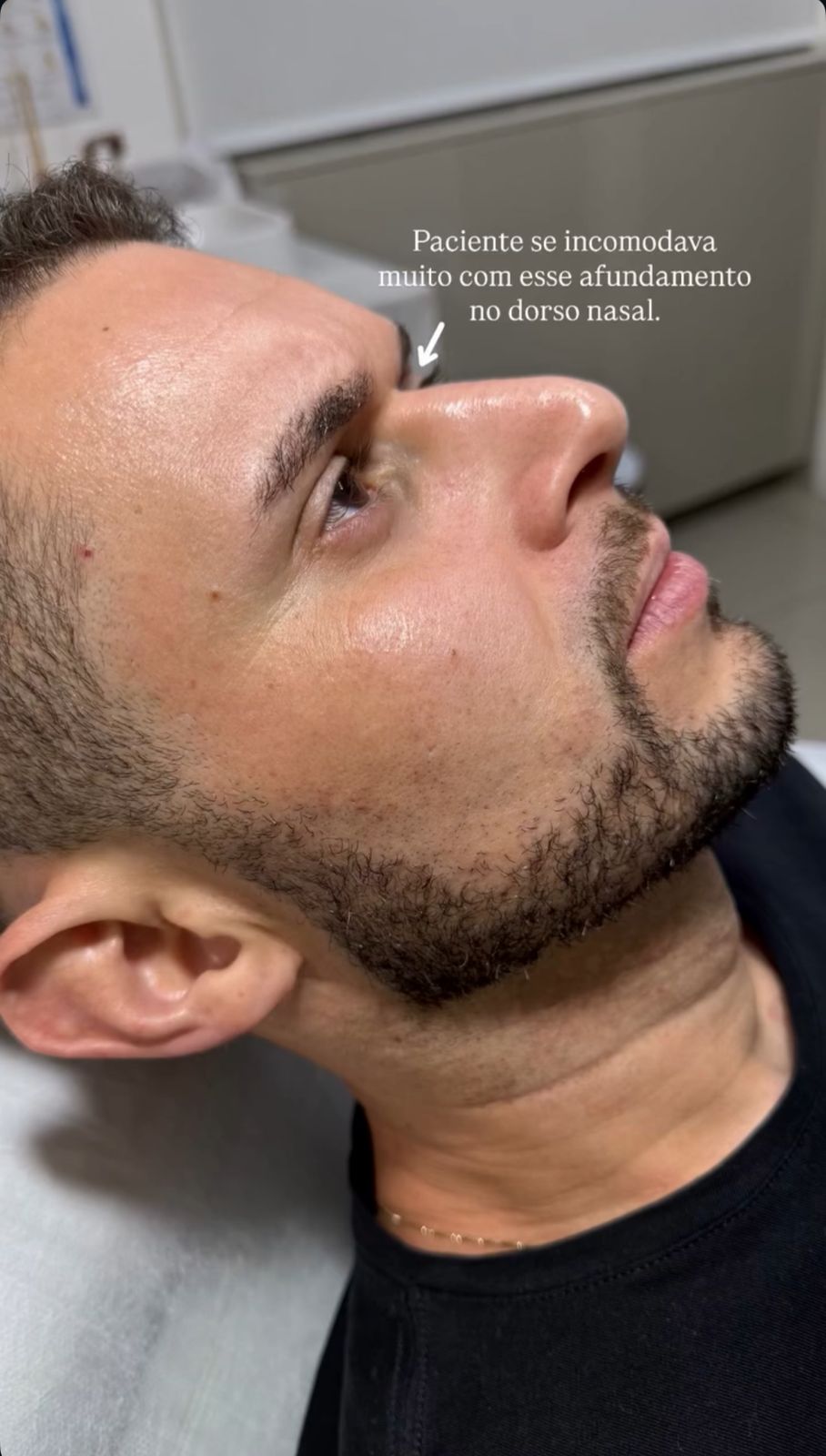 Antes - Rinomodelação