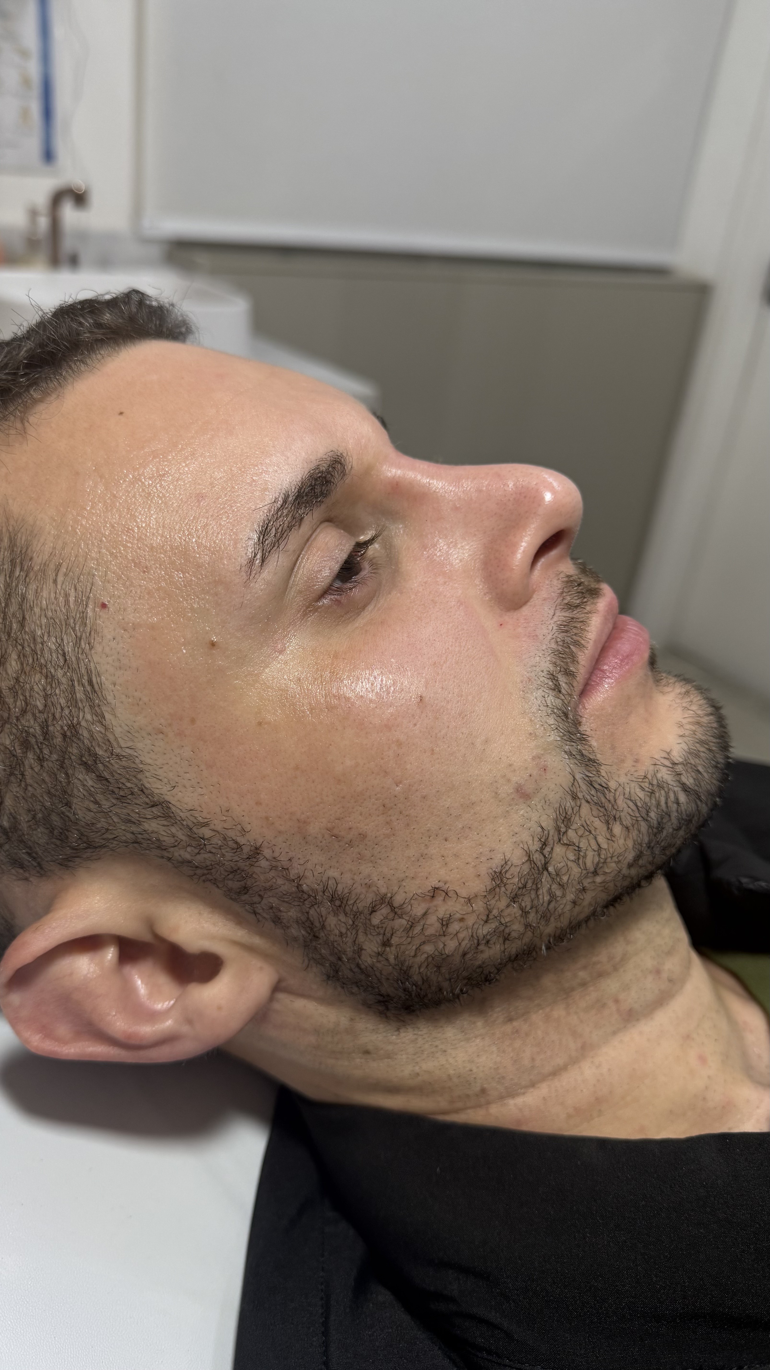 Depois - Rinomodelação