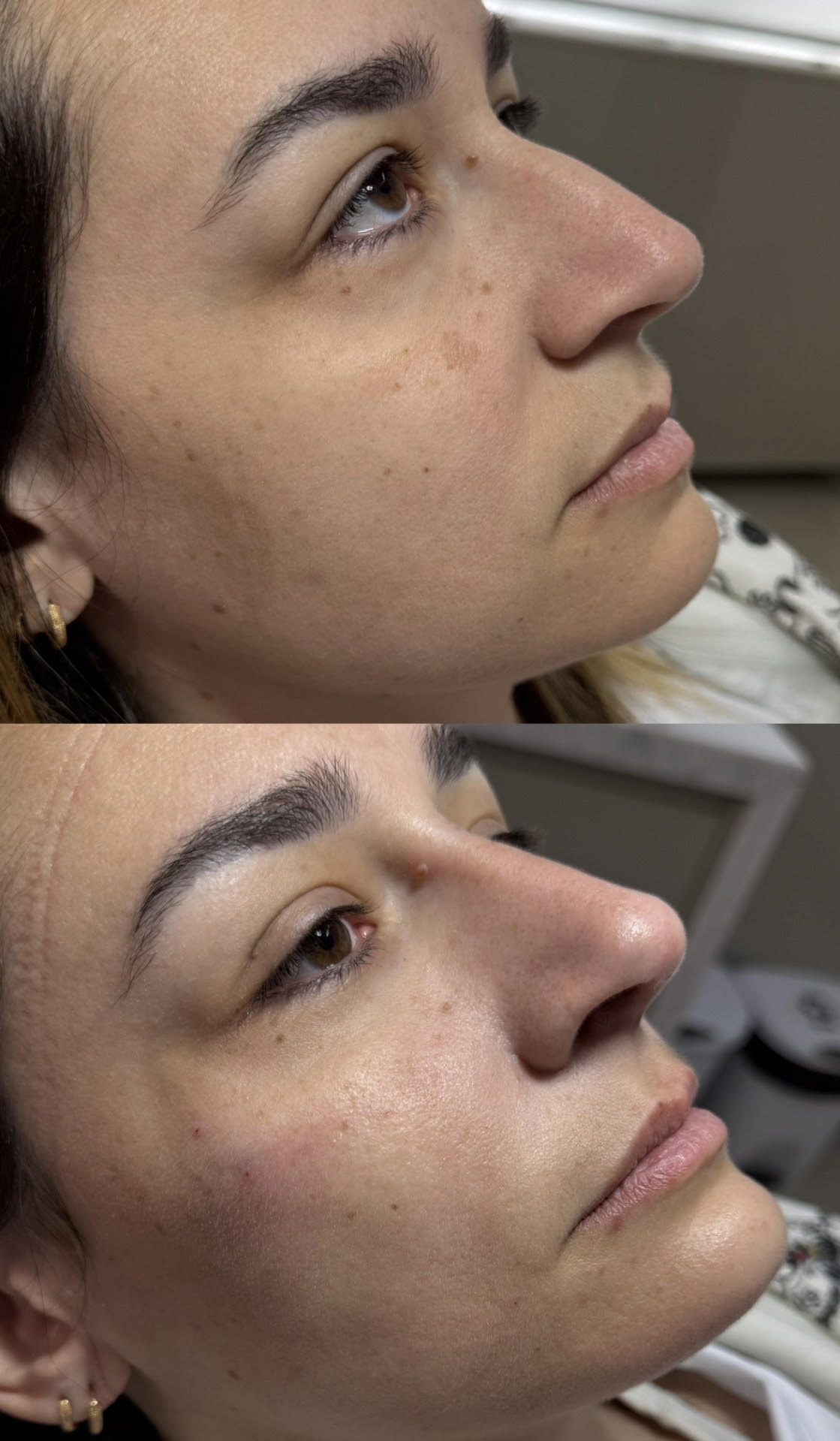 Resultado de Rinomodelação